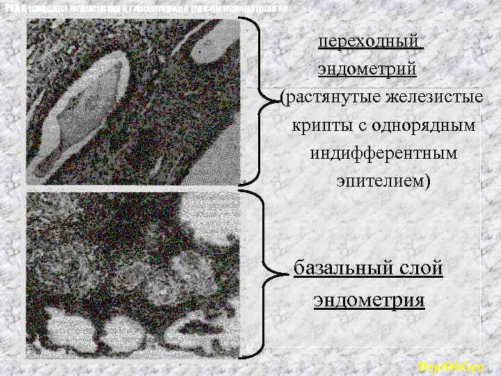РУДН, кафедра акушерства и гинекологии с курсом перинатологии переходный эндометрий (растянутые железистые крипты с