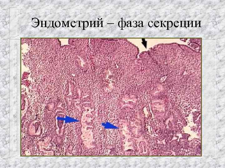 Эндометрий – фаза секреции 