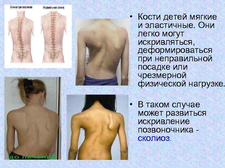  • Кости детей мягкие и эластичные. Они легко могут искривляться, деформироваться при неправильной