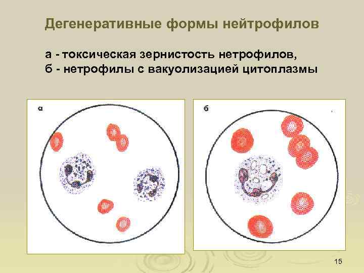 Дегенеративные формы нейтрофилов а - токсическая зернистость нетрофилов, б - нетрофилы с вакуолизацией цитоплазмы