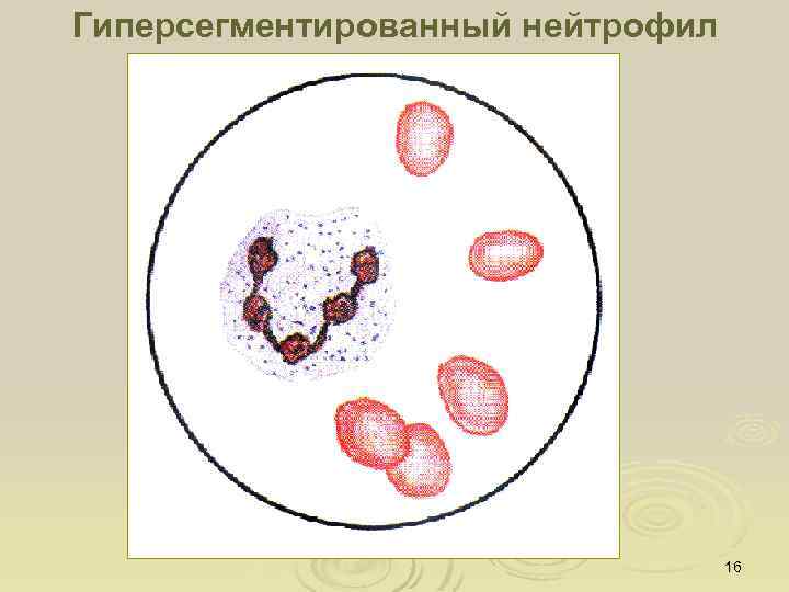 Гиперсегментированный нейтрофил 16 