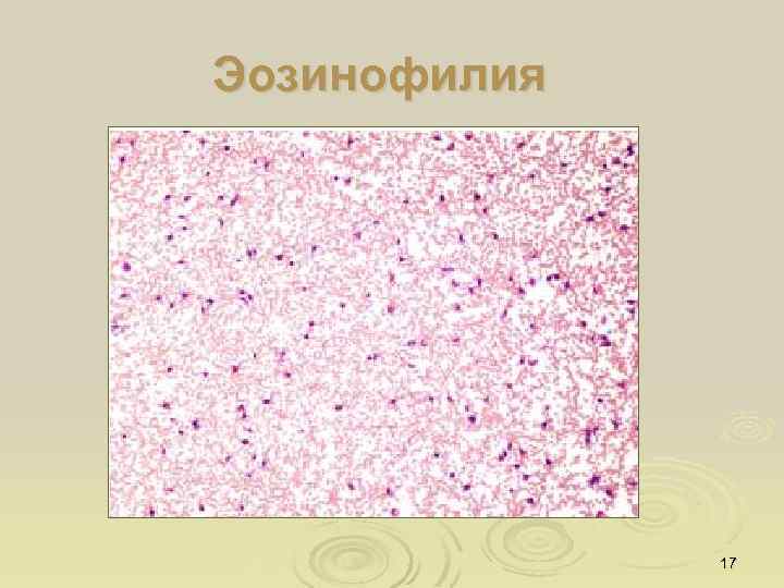 Эозинофилия 17 