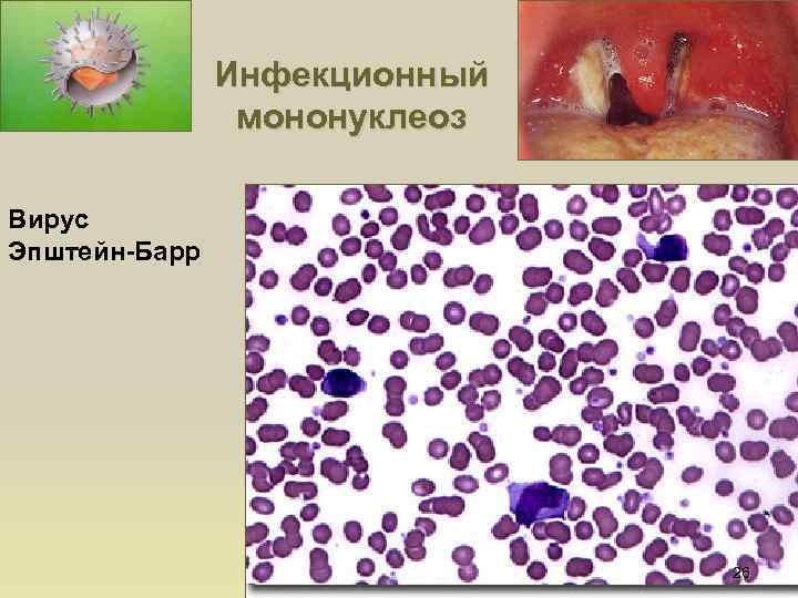 Инфекционный мононуклеоз Вирус Эпштейн-Барр 26 
