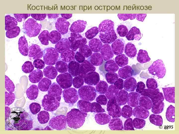 Костный мозг при остром лейкозе 39 