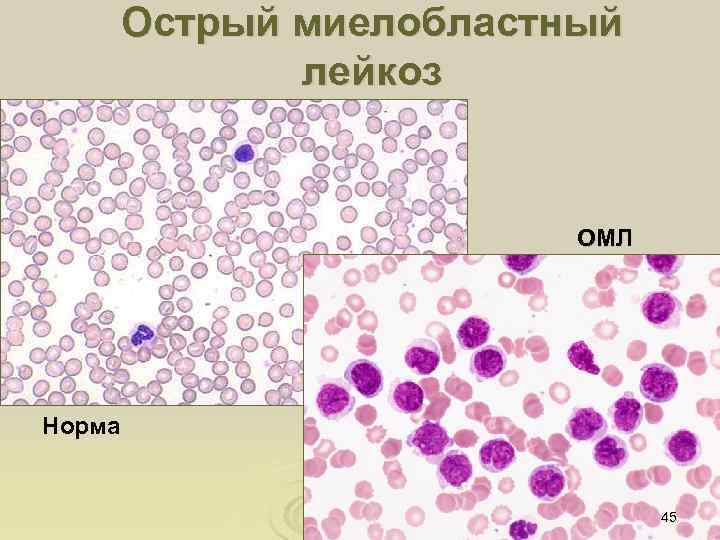 Острый миелобластный лейкоз ОМЛ Норма 45 