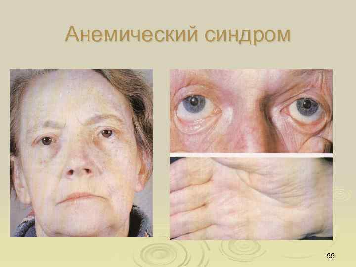Анемический синдром 55 