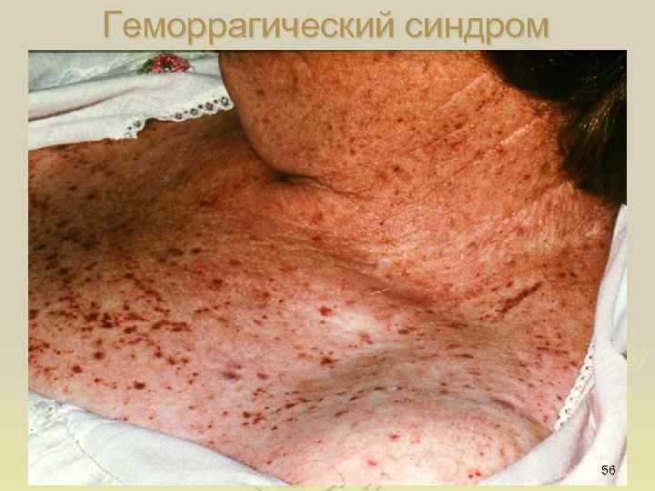 Геморрагический синдром 56 