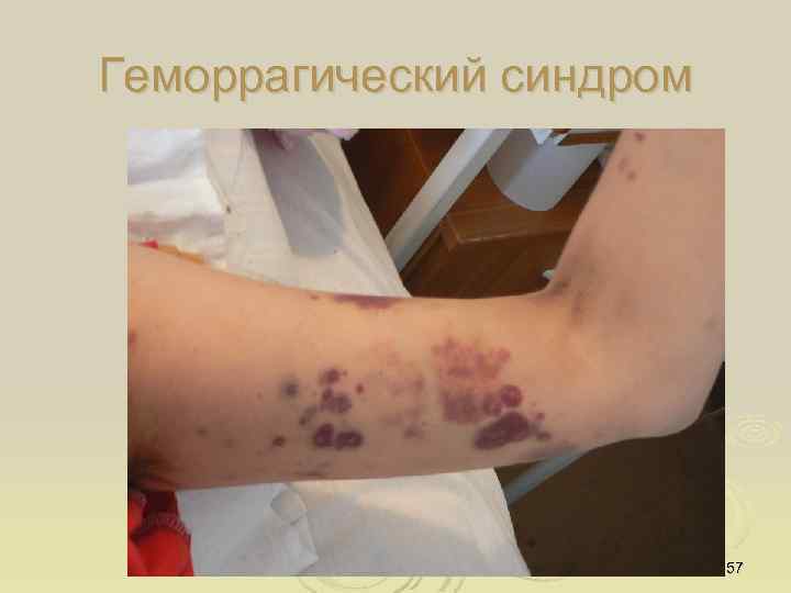 Геморрагический синдром 57 