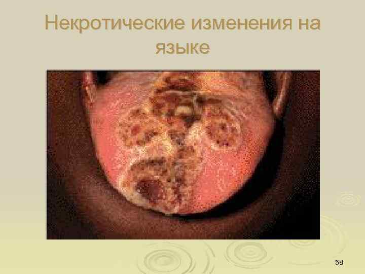 Некротические изменения на языке 58 
