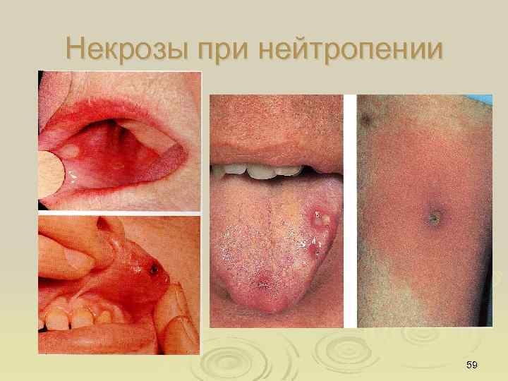 Некрозы при нейтропении 59 