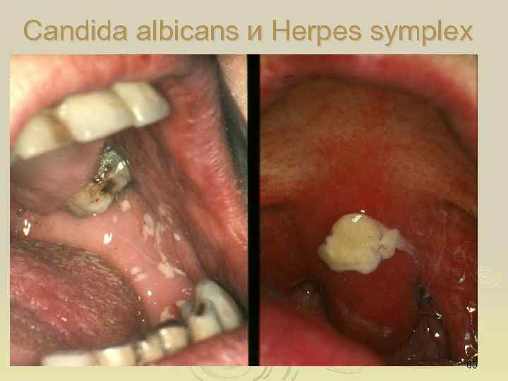 Candida albicans и Herpes symplex 60 