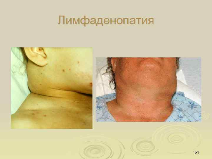 Лимфаденопатия 61 