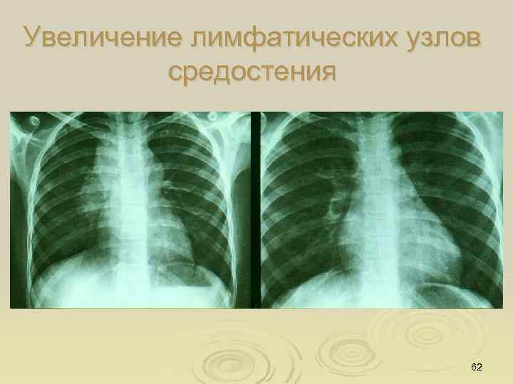 Увеличение лимфатических узлов средостения 62 