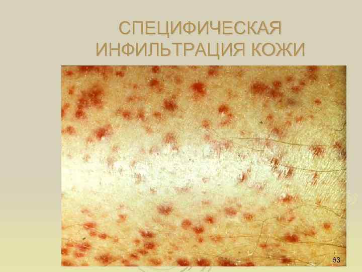 СПЕЦИФИЧЕСКАЯ ИНФИЛЬТРАЦИЯ КОЖИ 63 