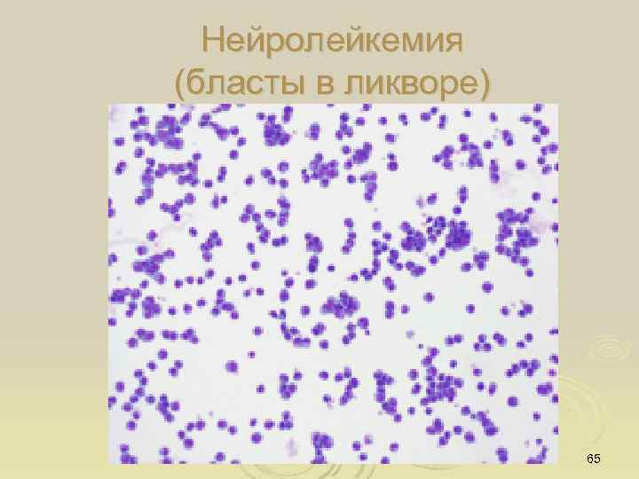 Нейролейкемия (бласты в ликворе) 65 