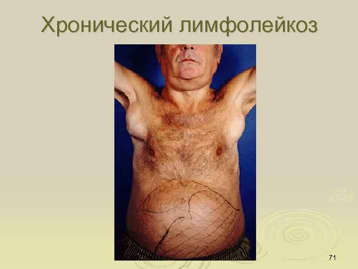 Хронический лимфолейкоз 71 