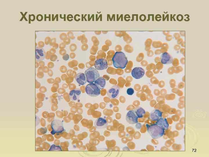 Хронический миелолейкоз 72 