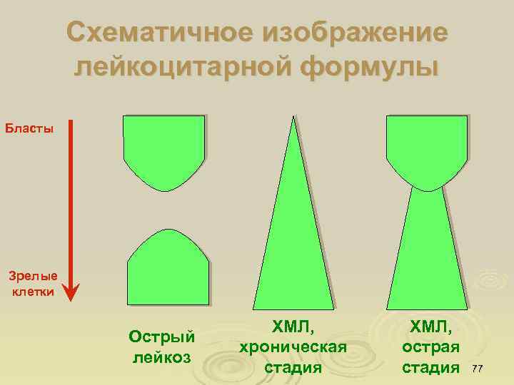 Схематичное изображение лейкоцитарной формулы Бласты Зрелые клетки Острый лейкоз ХМЛ, хроническая стадия ХМЛ, острая