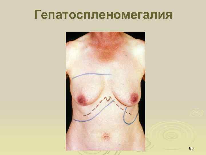 Гепатоспленомегалия 80 