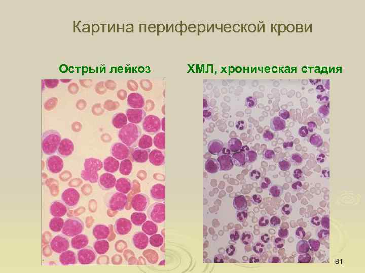 Картина периферической крови Острый лейкоз ХМЛ, хроническая стадия 81 