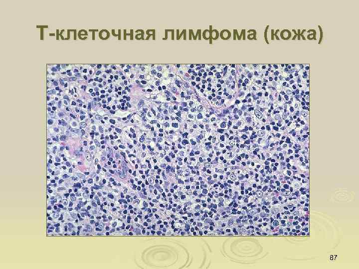 Т-клеточная лимфома (кожа) 87 