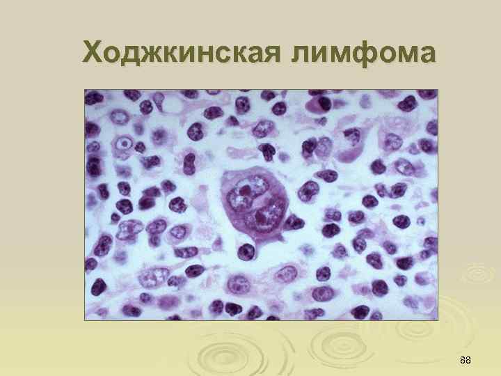 Ходжкинская лимфома 88 