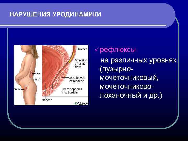 НАРУШЕНИЯ УРОДИНАМИКИ ü рефлюксы на различных уровнях (пузырномочеточниковый, мочеточниковолоханочный и др. ) 