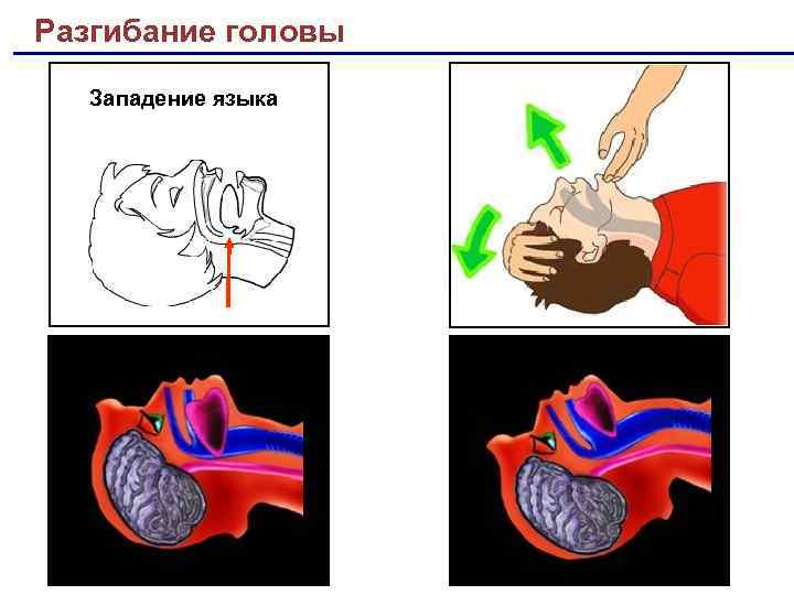 Разгибание головы Западение языка 