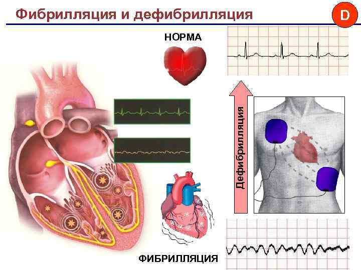 Фибрилляция и дефибрилляция Дефибрилляция НОРМА ФИБРИЛЛЯЦИЯ D 