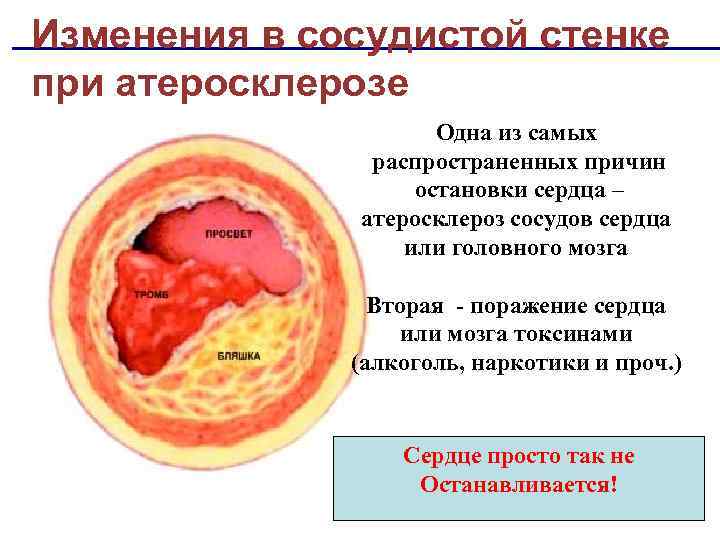 Изменения в сосудистой стенке при атеросклерозе Одна из самых распространенных причин остановки сердца –