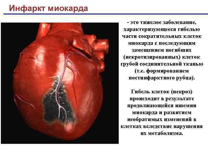 Инфаркт миокарда - это тяжелое заболевание, характеризующееся гибелью части сократительных клеток миокарда с последующим