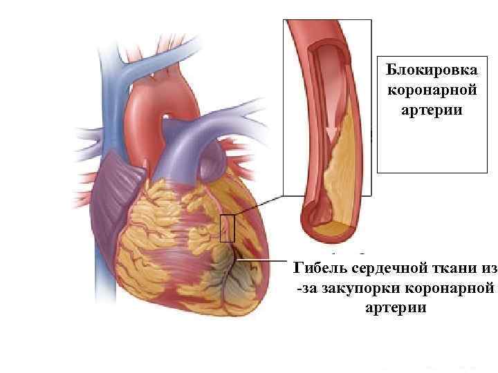 Блокировка коронарной артерии Гибель сердечной ткани из -за закупорки коронарной артерии 