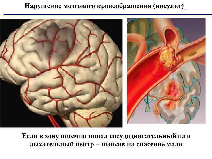 Нарушение мозгового кровообращения (инсульт)_ Если в зону ишемии попал сосудодвигательный или дыхательный центр –