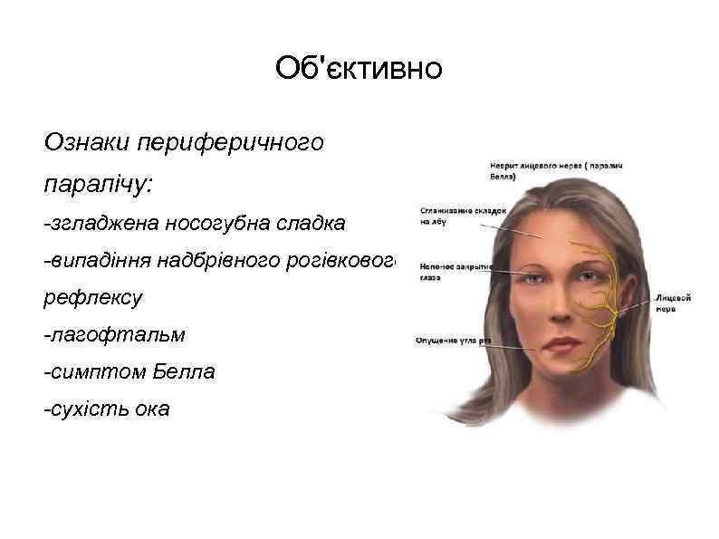 Об'єктивно Ознаки периферичного паралічу: -згладжена носогубна сладка -випадіння надбрівного рогівкового рефлексу -лагофтальм -симптом Белла