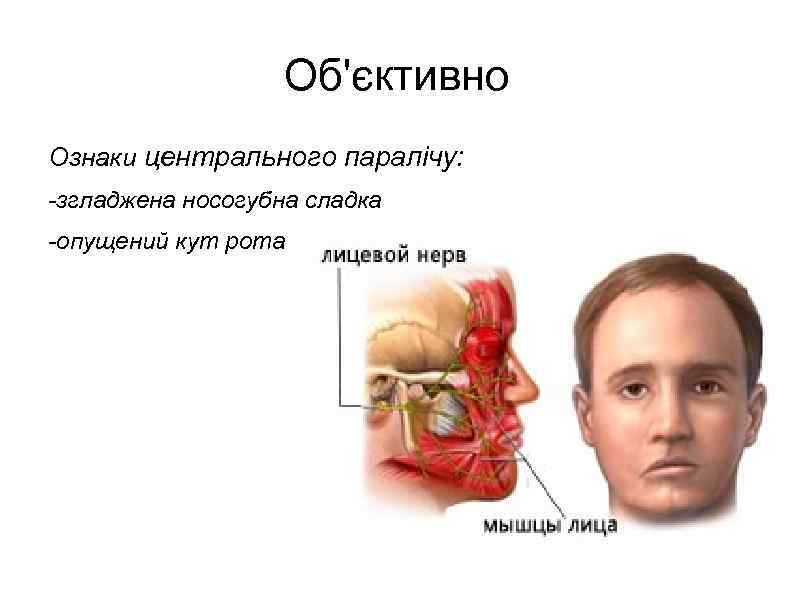 Об'єктивно Ознаки центрального паралічу: -згладжена носогубна сладка -опущений кут рота 