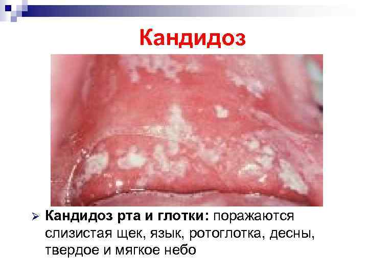 Кандидоз Ø Кандидоз рта и глотки: поражаются слизистая щек, язык, ротоглотка, десны, твердое и