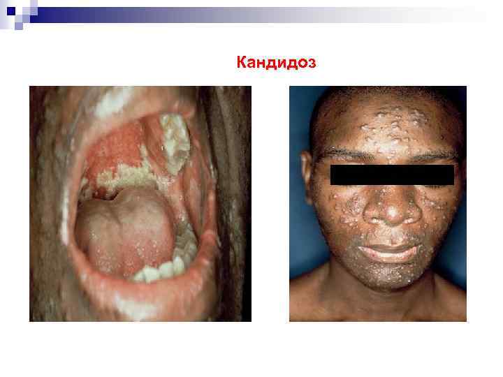 Кандидоз 