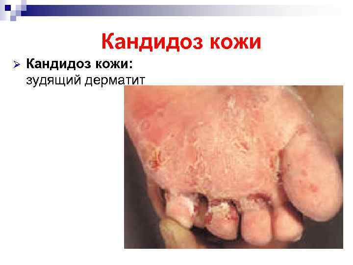 Кандидоз кожи Ø Кандидоз кожи: зудящий дерматит 