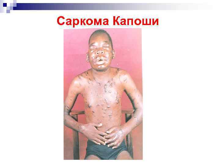 Саркома Капоши 