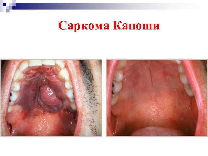 Саркома Капоши 