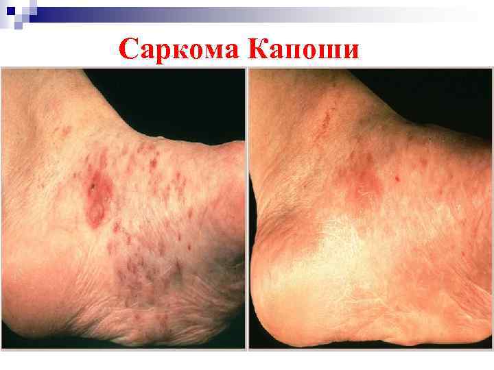 Саркома Капоши 