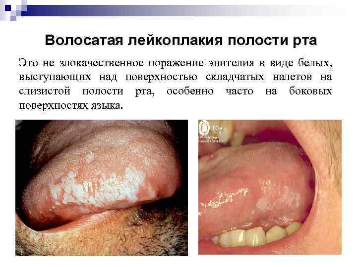 Волосатая лейкоплакия полости рта Это не злокачественное поражение эпителия в виде белых, выступающих над