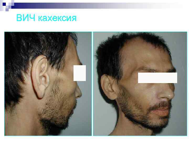 ВИЧ кахексия 