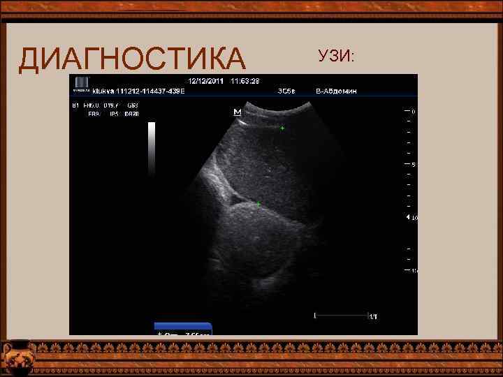 ДИАГНОСТИКА УЗИ: 