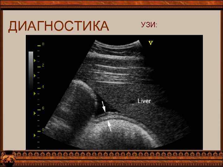 ДИАГНОСТИКА УЗИ: 