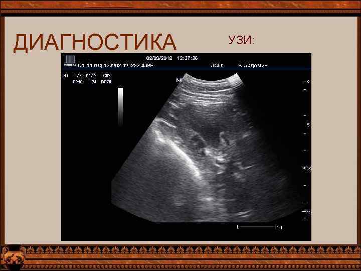 ДИАГНОСТИКА УЗИ: 