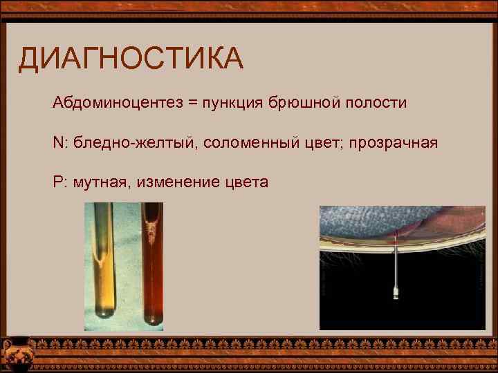 ДИАГНОСТИКА Абдоминоцентез = пункция брюшной полости N: бледно-желтый, соломенный цвет; прозрачная Р: мутная, изменение