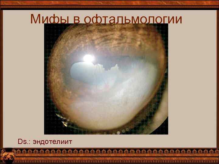Мифы в офтальмологии Ds. : эндотелиит 