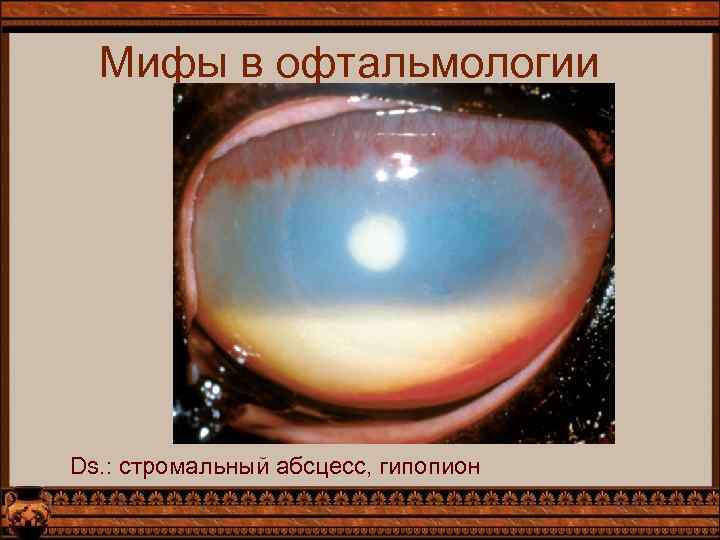 Мифы в офтальмологии Ds. : стромальный абсцесс, гипопион 