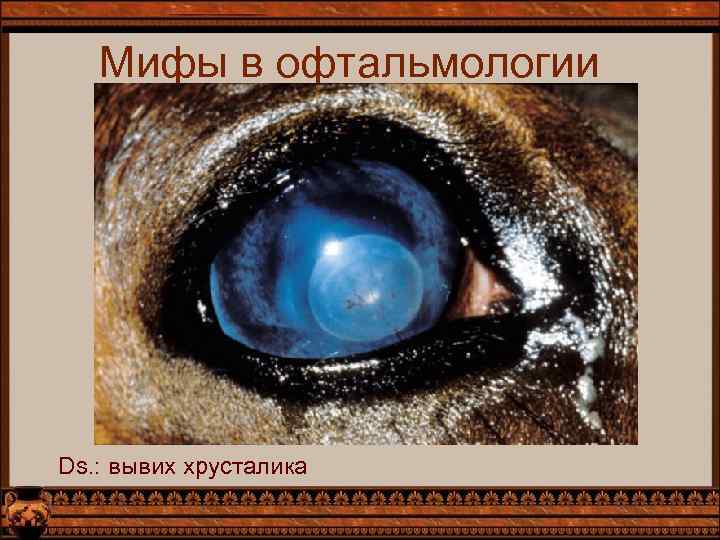 Мифы в офтальмологии Ds. : вывих хрусталика 